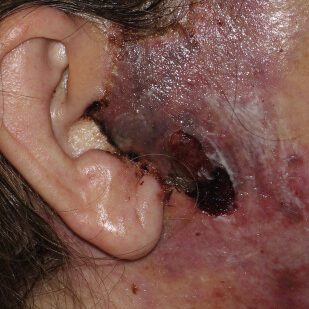 Некроза на кожата 16 дни след операцията. (източник: https://doi.org/10.1016/j.fsc.2020.06.007)